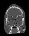 Base of skull fracture with bilateral Le Fort fractures (Radiopaedia 47094-51638 Coronal bone window 76).jpg