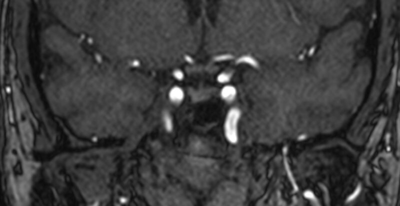 File:Basilar artery fenestration (Radiopaedia 74537-85455 Coronal MRA TOF 11).jpg