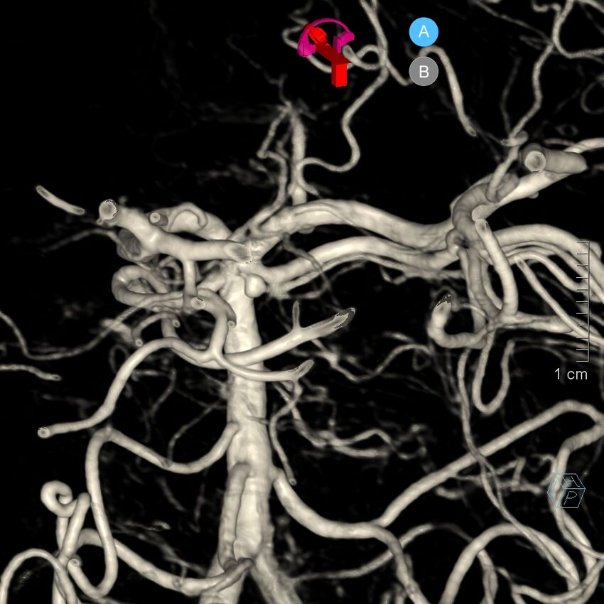 Basilar artery perforator aneurysm (Radiopaedia 82455-97734 3D view left VA 166).jpg