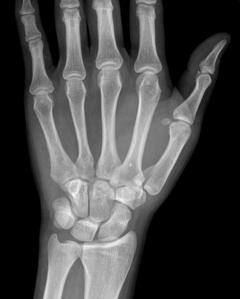 File:Bennett fracture (Radiopaedia 55586-62085 Frontal 1).png