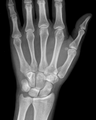 Bennett fracture (Radiopaedia 55586-62085 Frontal 1).png
