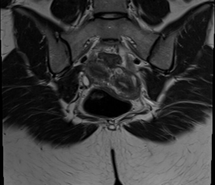 File:Bicornuate uterus (Radiopaedia 71214-81511 Coronal T2 7).jpg