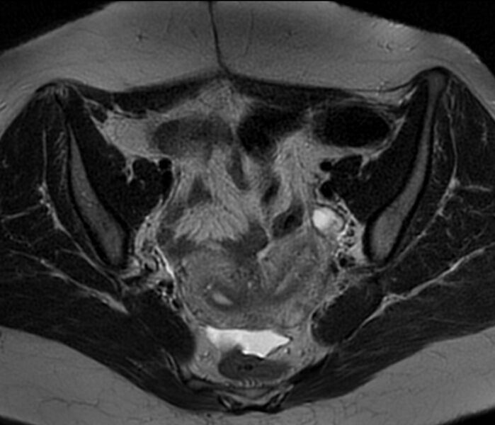 File:Bicornuate uterus (Radiopaedia 76407-88114 Axial T2 10).jpg