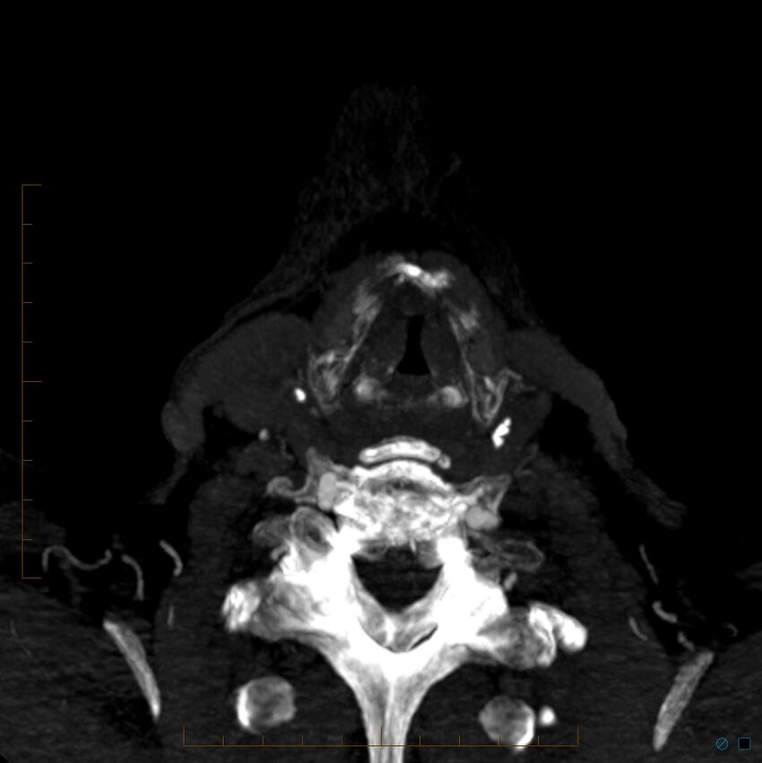 Bilateral chronic common carotid occlusion (Radiopaedia 50849-56362 D 45).jpg