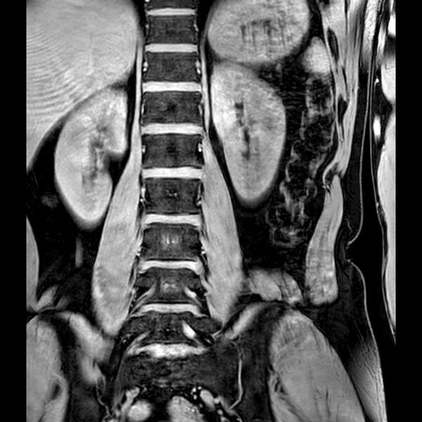 File:Bilateral conjoined nerve roots at different levels (Radiopaedia 73312-84063 B 25).jpg