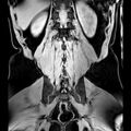 Bilateral conjoined nerve roots at different levels (Radiopaedia 73312-84063 Coronal WE 43).jpg