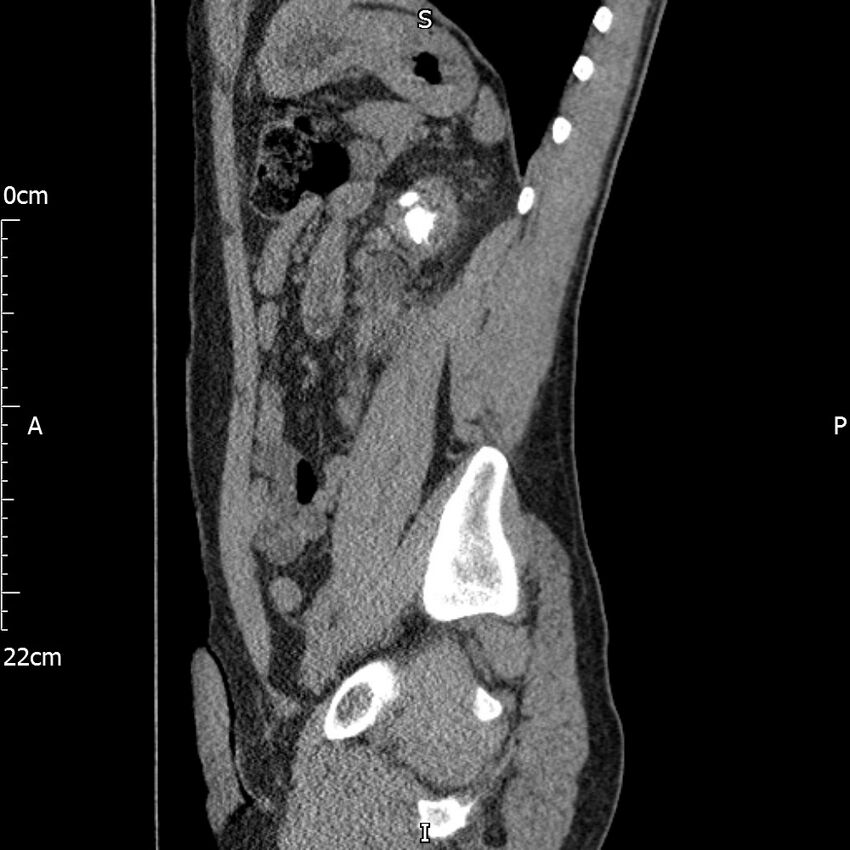Bilateral medullary nephrocalcinosis with ureteric calculi (Radiopaedia 71269-81569 C 43).jpg