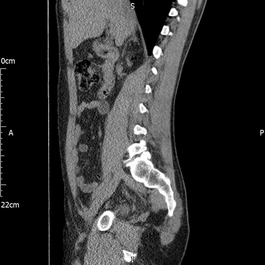 Bilateral medullary nephrocalcinosis with ureteric calculi (Radiopaedia 71269-81569 C 72).jpg