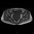 Bilateral ovarian fibroma (Radiopaedia 44568-48293 Axial T1 14).jpg