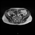 Bilateral ovarian fibroma (Radiopaedia 44568-48293 Axial T2 5).jpg
