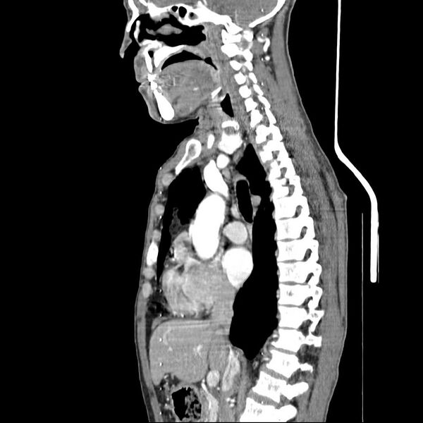 File:Bilateral parotid gland lymphoma (Radiopaedia 21038-20969 C 11).jpg