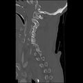 Bilateral perched facets with cord injury (Radiopaedia 45587-49713 Sagittal bone window 16).jpg