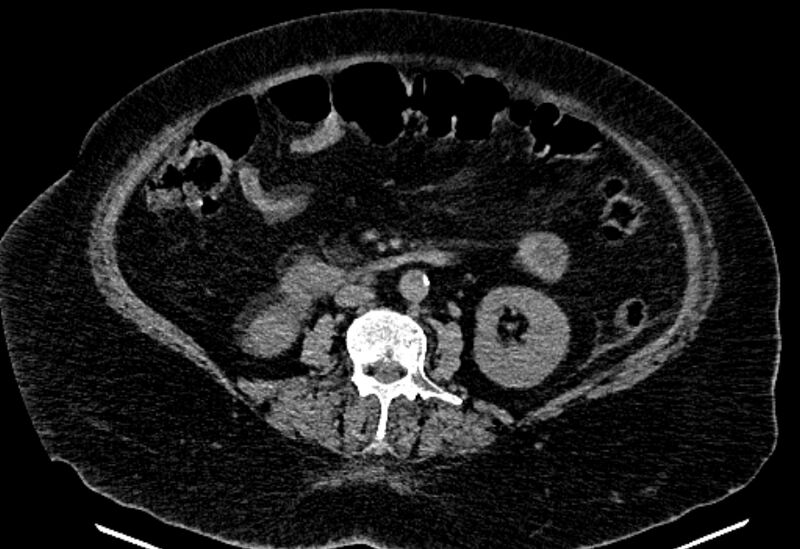 File:Biliary pancreatitis (Radiopaedia 72289-82823 Axial non-contrast 138).jpg