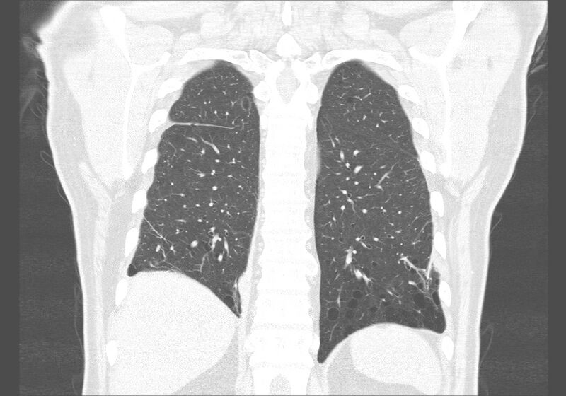 File:Birt-Hogg-Dubé syndrome (Radiopaedia 52578-58491 Coronal lung window 49).jpg