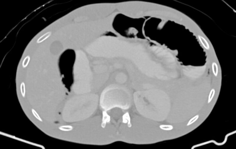 File:Blunt injury to the small bowel (Radiopaedia 74953-85987 Axial Wide 20).jpg
