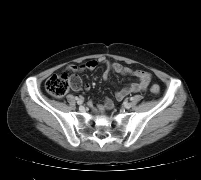 File:Bosniak renal cyst - type IV (Radiopaedia 22929-22953 C 50).jpg