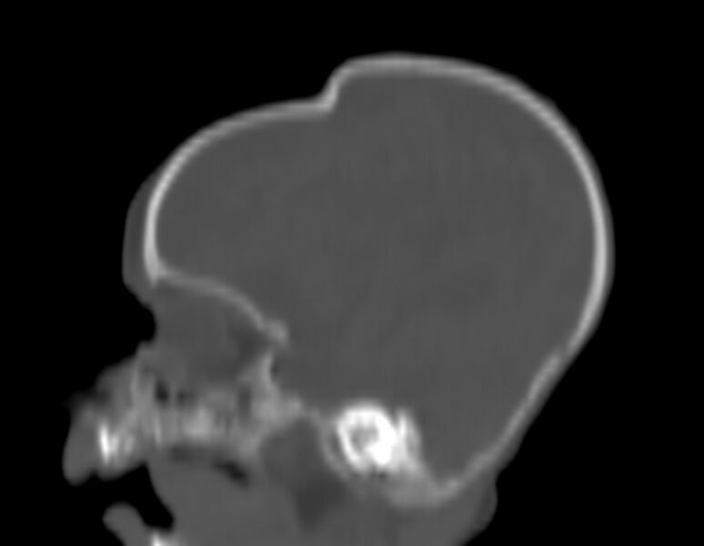 File:Brachycephaly (bi-coronal and bi-lambdoid synostosis) (Radiopaedia 55048-61413 Sagittal bone window 12).jpg