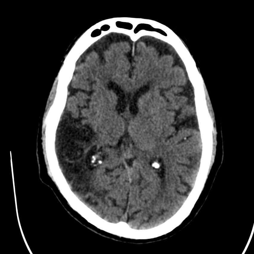 Brain Pantopaque remnants (Radiopaedia 78403-91048 Axial non-contrast 52).jpg