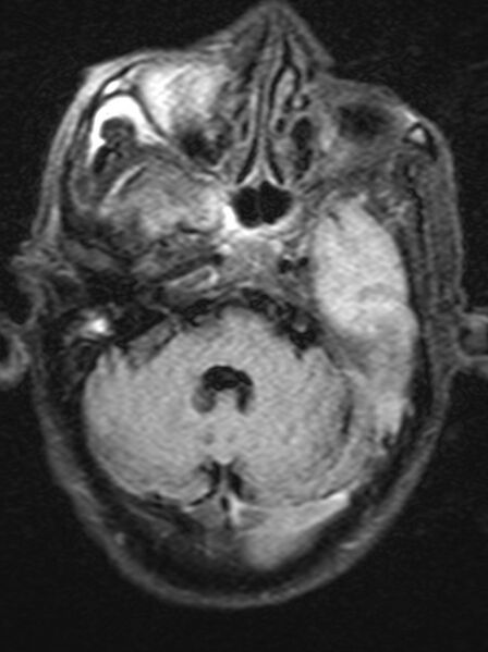 File:Brain abscess with dual rim sign (Radiopaedia 87566-103938 Axial FLAIR 5).jpg