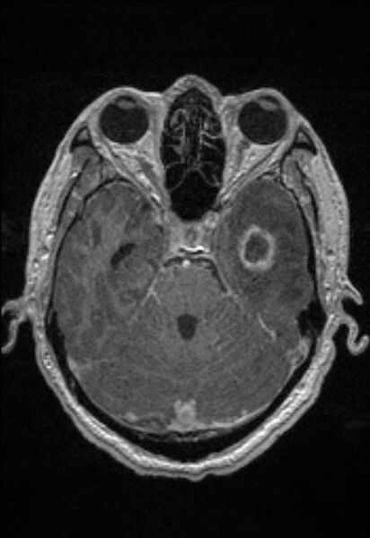 File:Brain abscess with ventriculitis (Radiopaedia 85703-101495 Axial T1 C+ 62).jpg