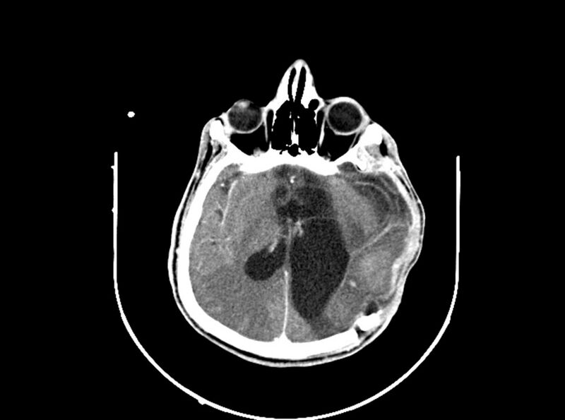 File:Brain injury by firearm projectile (Radiopaedia 82068-96088 B 130).jpg