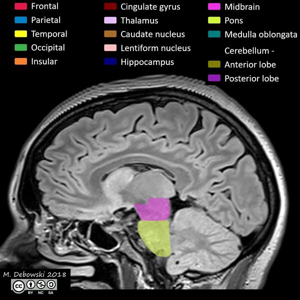 File:Brain lobes - annotated MRI (Radiopaedia 61691-69700 Sagittal 34).JPG
