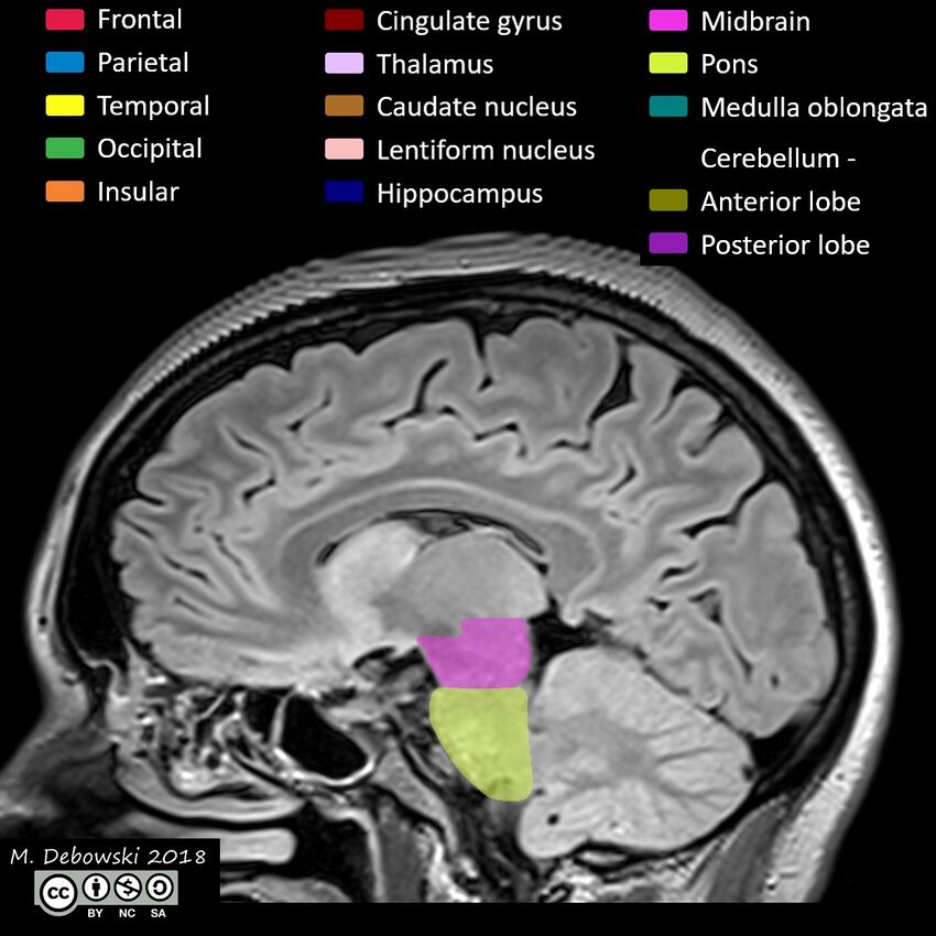 Brain lobes - annotated MRI (Radiopaedia 61691-69700 Sagittal 34).JPG