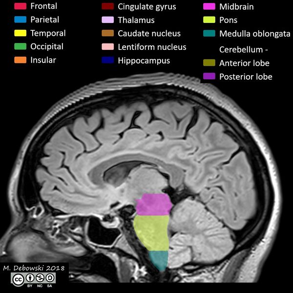 File:Brain lobes - annotated MRI (Radiopaedia 61691-69700 Sagittal 36).JPG