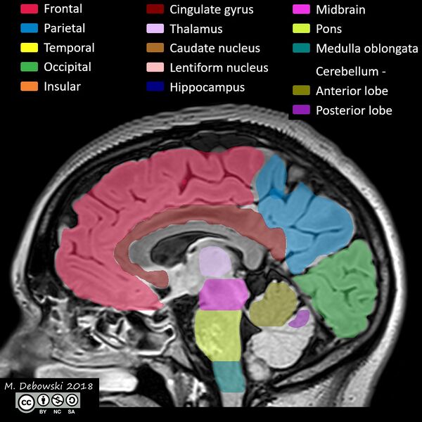 File:Brain lobes - annotated MRI (Radiopaedia 61691-69700 Sagittal 41).JPG