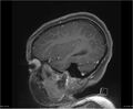 Brainstem glioma (Radiopaedia 21819-21775 D 34).jpg