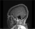 Brainstem glioma (Radiopaedia 21819-21775 D 6).jpg