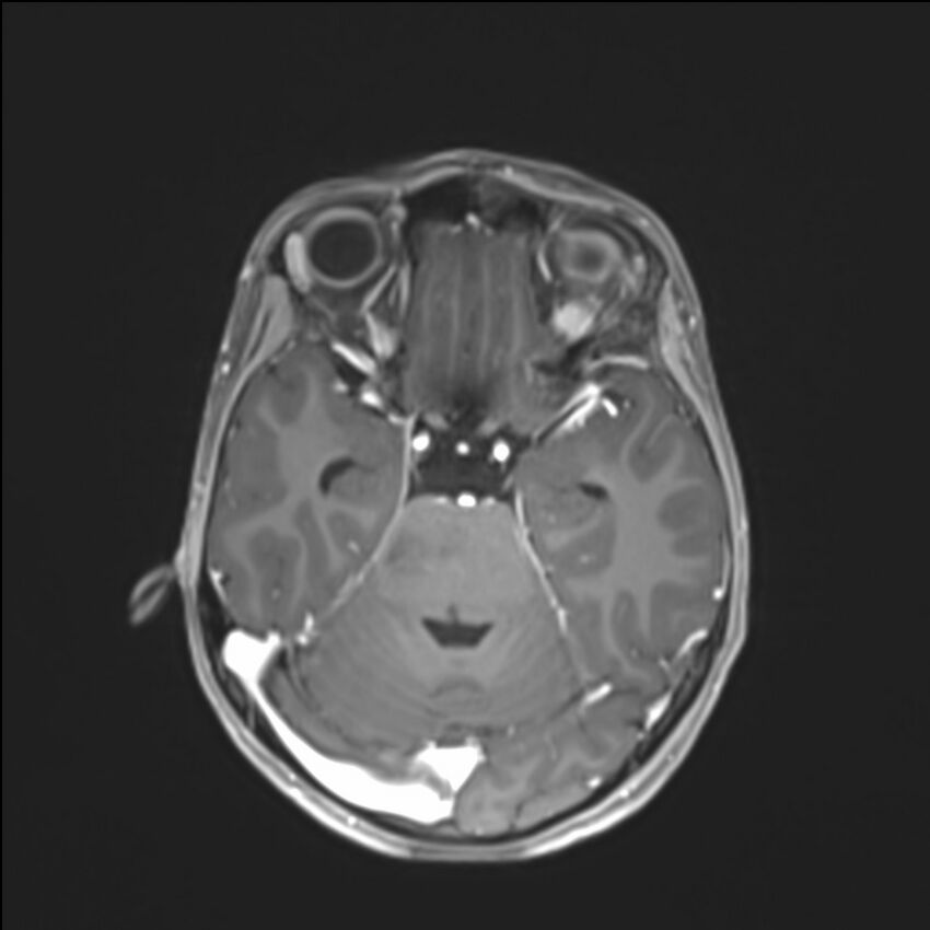 Brainstem glioma (Radiopaedia 70548-80674 Axial T1 C+ 60).jpg
