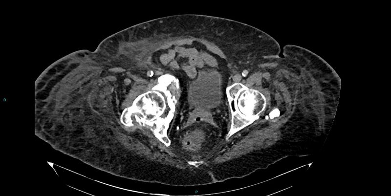 File:Breast cancer pelvic bony metastases (Radiopaedia 84470-99824 Axial bone window 56).jpg