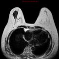 Breast carcinoma (multicentric multifocal in mammary Paget disease) (Radiopaedia 50966-56512 Axial T2 4).jpg