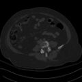 Breast carcinoma with pathological hip fracture (Radiopaedia 60314-67993 Axial bone window 4).jpg