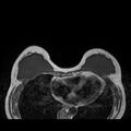 Breast implants - MRI (Radiopaedia 26864-27035 Axial T1 19).jpg