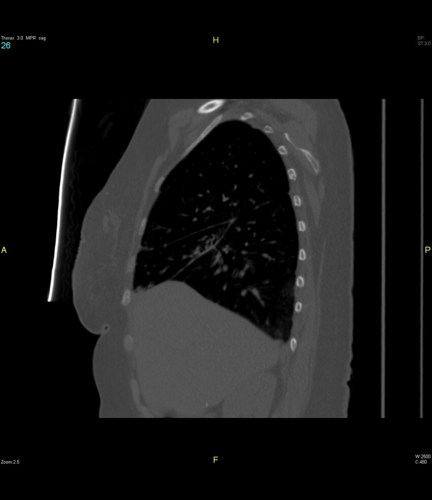 Breast primary with lung and bone metastases (Radiopaedia 40620-43228 Sagittal bone window 26).jpg