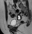 Broad ligament leiomyoma (Radiopaedia 81634-95516 Sagittal T2 10).jpg