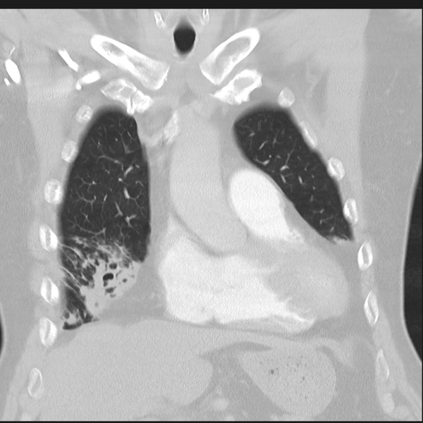 File:Bronchiectasis (Radiopaedia 39385-41666 Coronal lung window 8).png