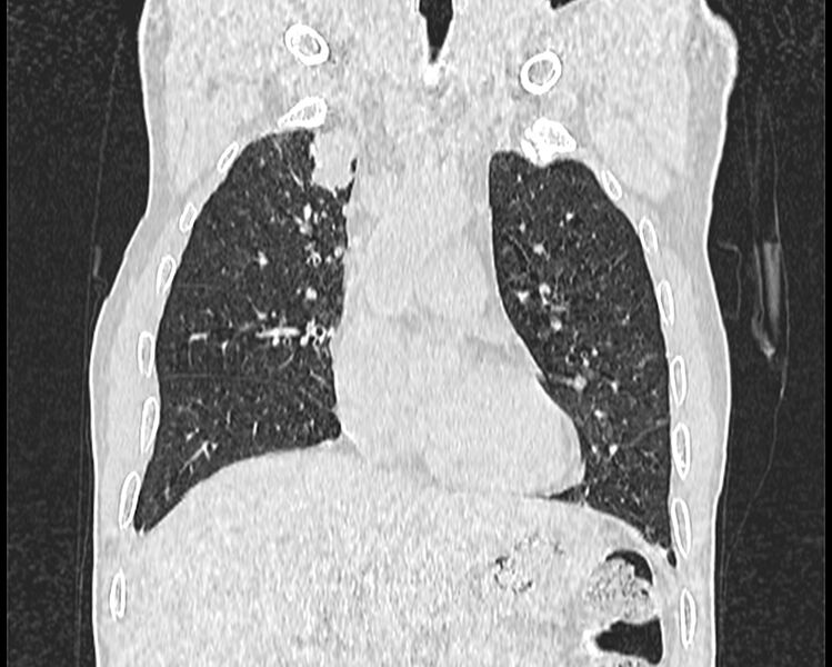 File:Bronchogenic carcinoma with superior vena cava syndrome (Radiopaedia 36497-38054 Coronal lung window 8).jpg