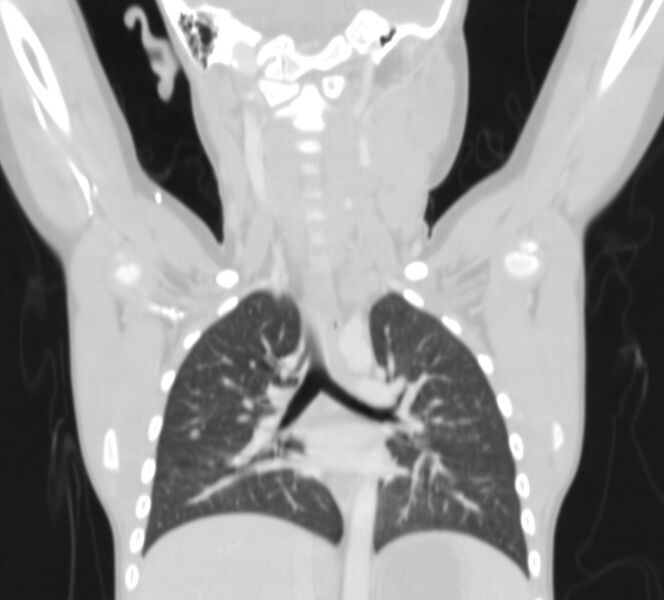 File:Bronchus suis (Radiopaedia 68131-77620 Coronal lung window 14).jpg