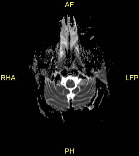 File:Butterfly glioma (Radiopaedia 76707-88526 Axial ADC 3).jpg