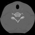 C5 facet fracture (Radiopaedia 58374-65499 Axial bone window 65).jpg