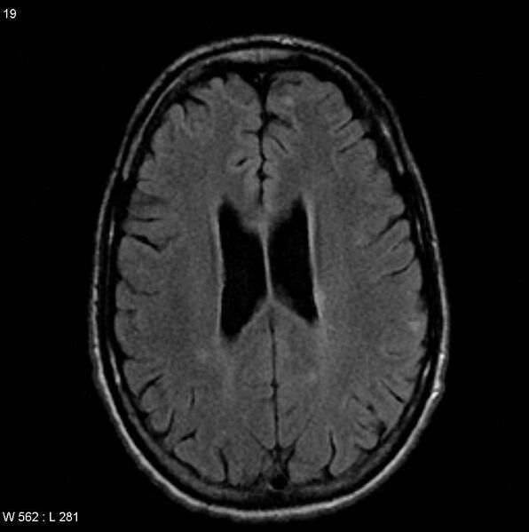 File:CMV ventriculitis and encephalitis (Radiopaedia 5416-7166 Axial FLAIR 7).jpg