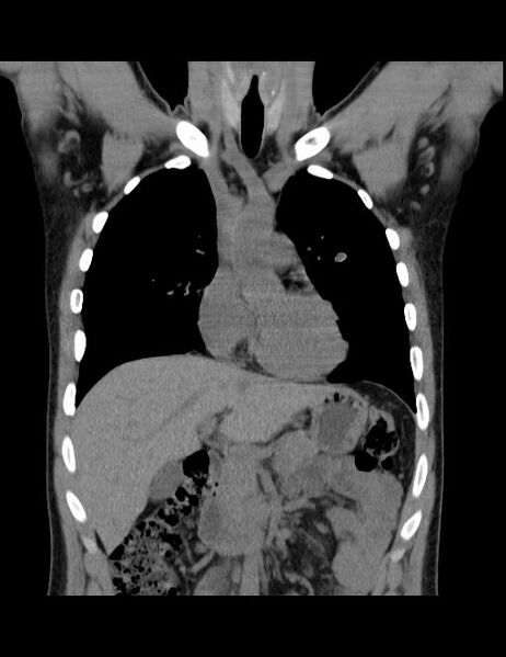 File:Calcifying pulmonary metastases (Radiopaedia 33359-34396 Coronal non-contrast 30).jpg