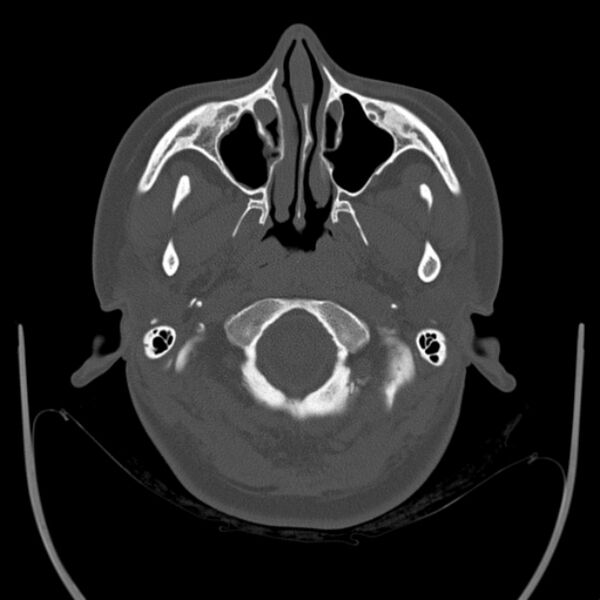 File:Calvarial osteoma (Radiopaedia 36520-38079 Axial bone window 12).jpg
