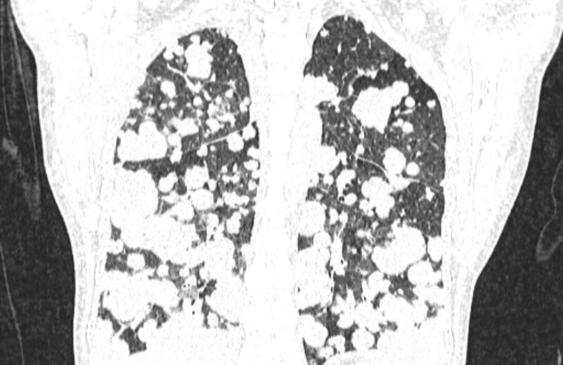 File:Cannonball metastases from breast cancer (Radiopaedia 91024-108569 Coronal lung window 103).jpg
