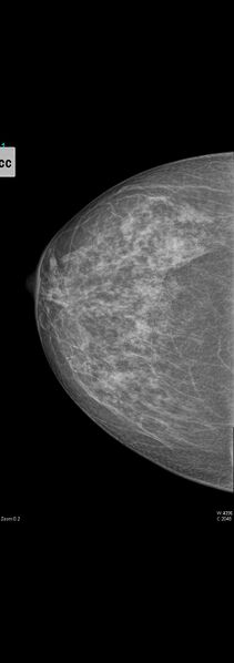 File:Carcinoma of left breast (Radiopaedia 28504-28746 D 1).jpg