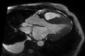 Cardiac amyloidosis (Radiopaedia 61600-69579 B 6).jpg