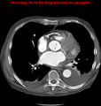 Cardiac perforation following transcatheter aortic valve implantation (Radiopaedia 23714-23863 A 4).png